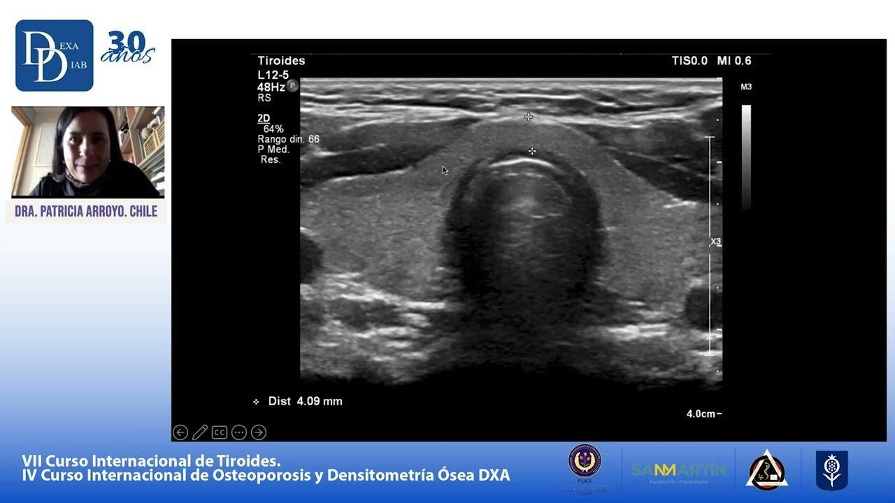 Ecografía Funcional para Patología Tiroidea