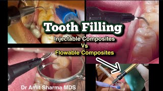 Tooth filling | Injectable composite vs Flowable composite | Best dental fillings