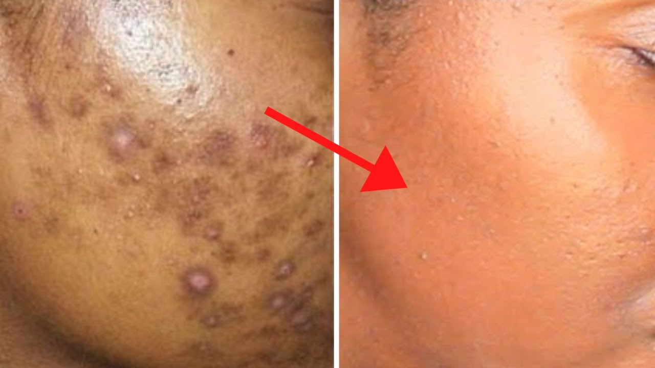 How to Get Rid of Acne Scars Overnight: Remove Them FAST