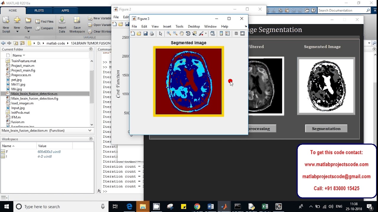 Fusion of PET and MR Brain Images to Detect Brain Tumor-matlab projects ...