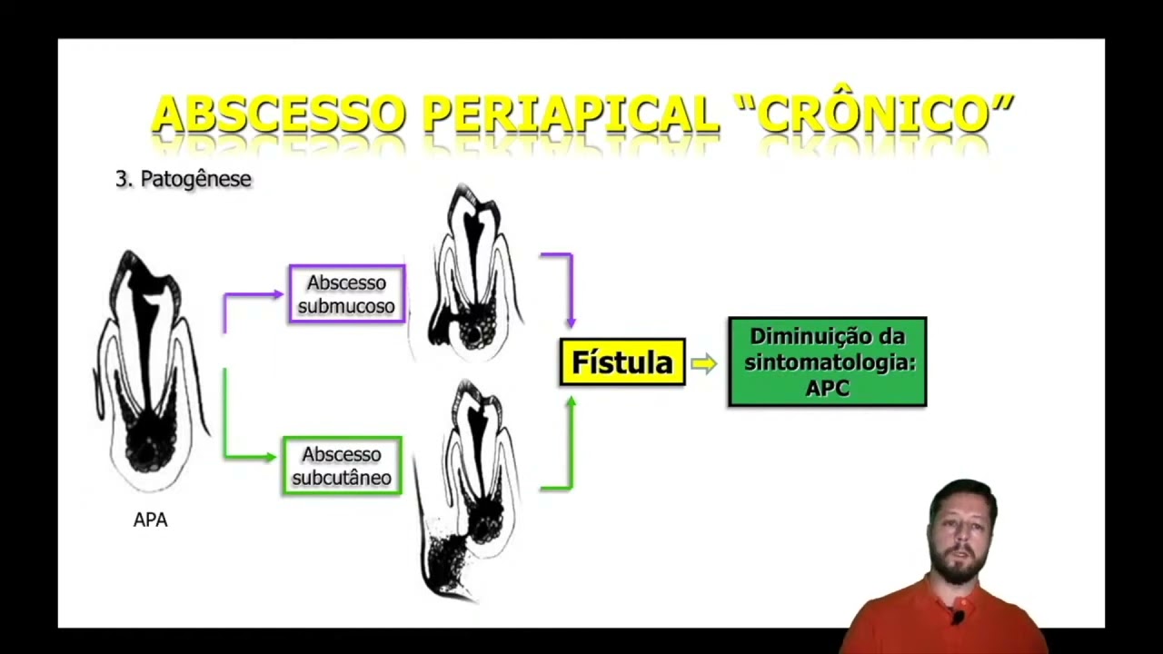 Doenças periapicais: Abscesso periapical crônico