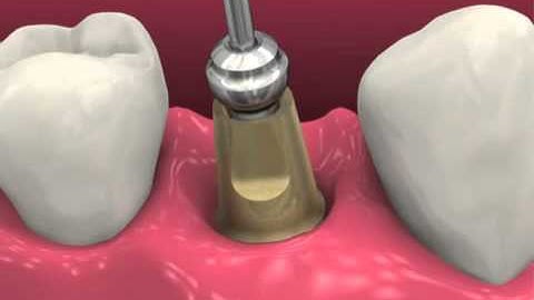 Restoring BioHorizons Dental Implants (2011)