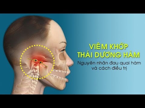 Viêm khớp thái dương hàm (TMJ) gây đau quai hàm và cách điều trị.