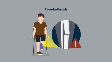 "Molecular Evidence Supporting MEK Inhibitor Therapy in NF1 Pseudarthrosis" by Paria et al.