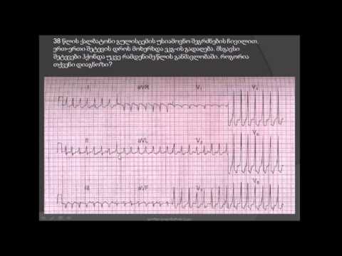 ვიწროკომპლექსიანი ტაქიკარდია (ელექტროკარდიოგრაფიის საფუძვლები) / viwrokompleqsiani taqikardia (ECG)