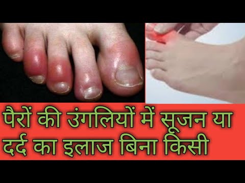 पैरों की उंगलियों में सूजन या दर्द का इलाज बिना किसी दवा