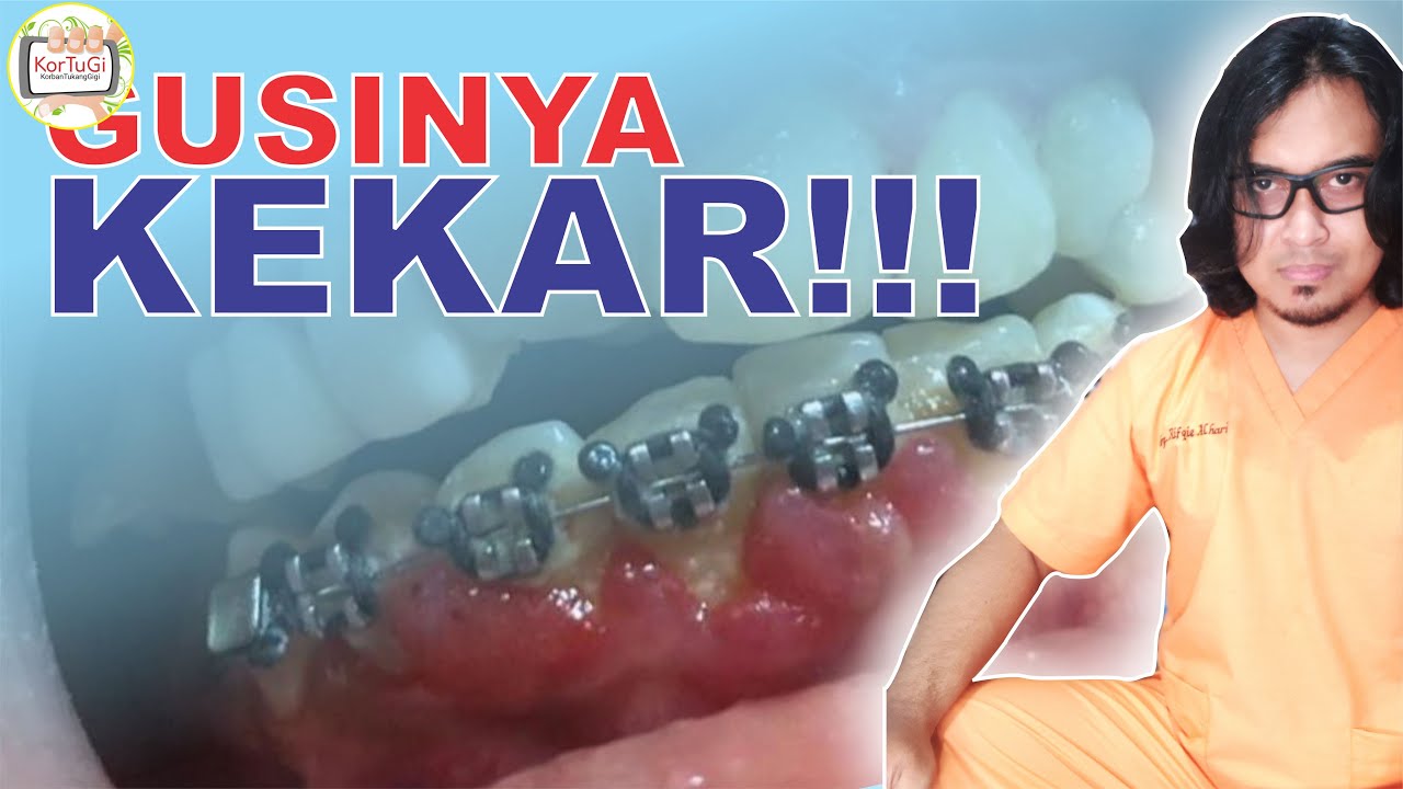 KARET MIKI DAN GUSI KEKAR by Salon Behel dan Veneer | KorTuGi