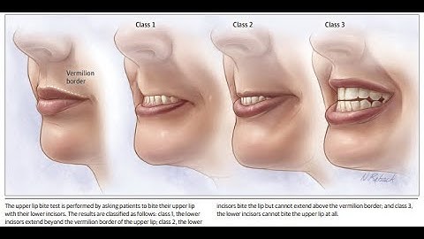 Difficult Intubation- Summary Video
