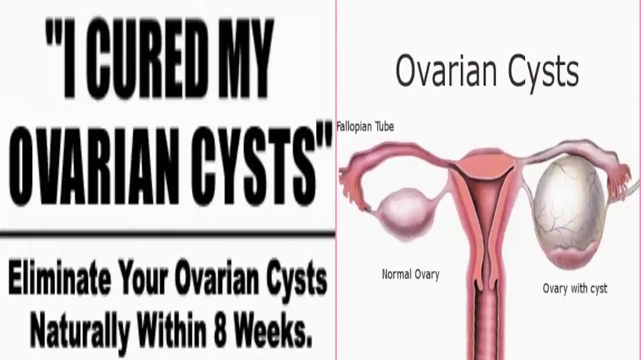 Ovarian Cyst Removal How To Remove Ovarian Cyst Without Surgery YouTube