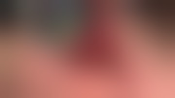 Physics Forceps Extraction of Upper Right Bicuspid from GoldenDent, Atraumatic Extraction