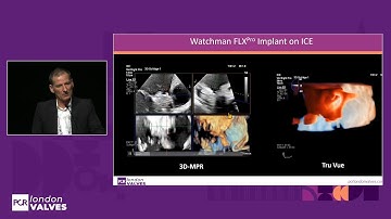 The next frontier in LAA closure: innovations and opportunities - PCR London Valves 2025