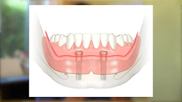 Wie funktioniert die Druckknopfprothese?