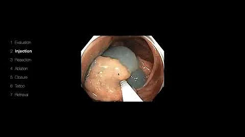 Zoom Class - Endoscopy Refresher - Large Colon Pol...