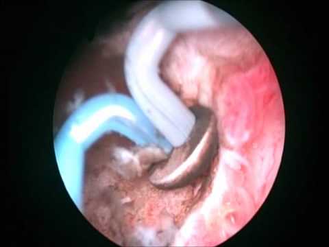 turis prostatectomy