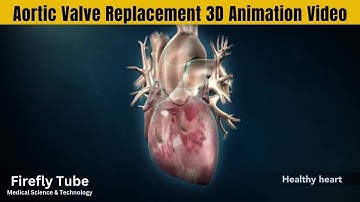 Aortic Valve Replacement 3D Animation Video