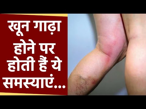 Body में Thick Blood होने पर होती हैं ये Problems, Natural Way से करें पतला | Boldsky