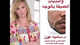 علاج الحفر والندبات العميقة بالوجه مع د.ساميه عون-عيادة د.محمد التهامي