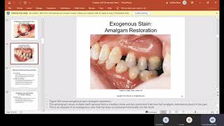 Chapter 58 Coronal Polishing