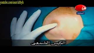 sebaceous cyst excision عملية استئصال الكيس الشمعى