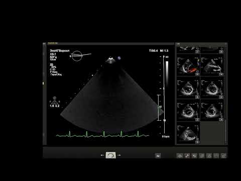 УЗИ сердца (эхокардиография) Истинный Пролапс МК . В конце видео - бонус!  3 D измерения объемов .