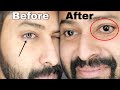 Wearing color lens gone wrong  first time color lens must watch before using  shadhik azeez