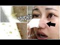 watch me cry while peeling off "blackheads"