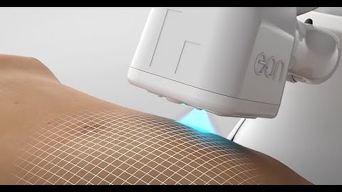 Transform Your Body with EON Robotic Laser Liposuction l 3D animation