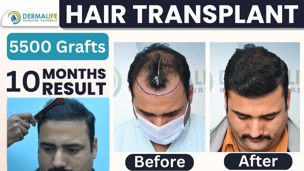 Repair Hair Transplant Before And After Results | Grade 5 Baldness 5500  Grafts | Case Study #delhi - YouTube