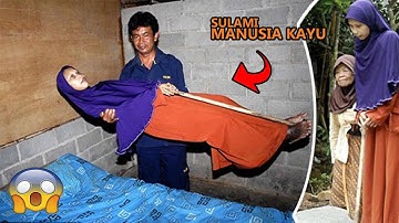 PENYAKIT LANGKA Yang Di Derita Sulami...Manusia Kayu
