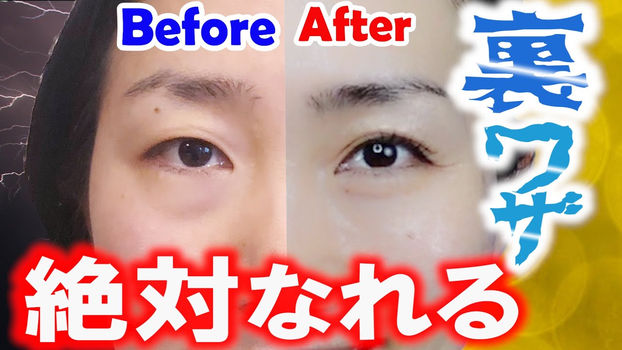 สถ ต คล ปว ด โอ Youtube สำหร บ 整形 厚ぼったい一重がぱっちり二重に変身 埋没法と瞼の脂肪取りの施術を大公開 ぷりふろっぷコラボ Before After Noxinfluencer