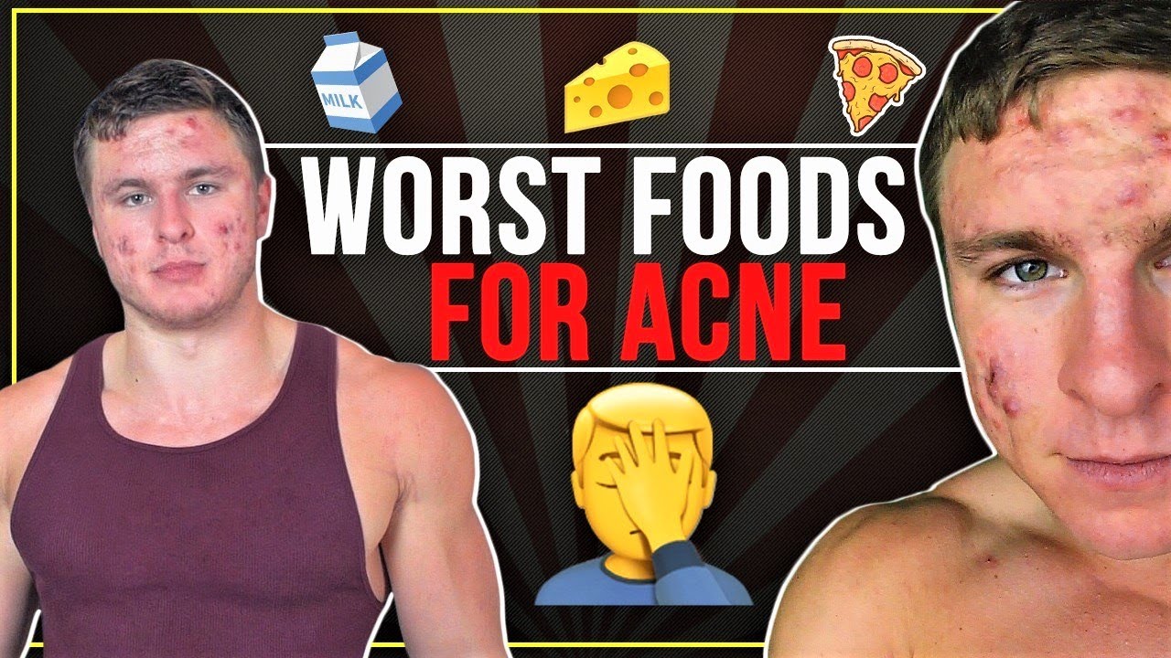 I Look At My Diet When My Acne Was It's Worst | IT'S SHOCKING 😲