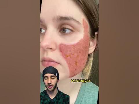 плазменная ручка для омоложения - YouTube