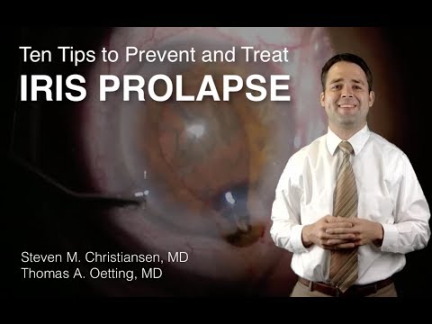 Ten Tips to Prevent and Treat Iris Prolapse