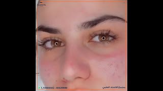 جلسة هيدرافيشيل (هيدراكول) | Hydra Facial