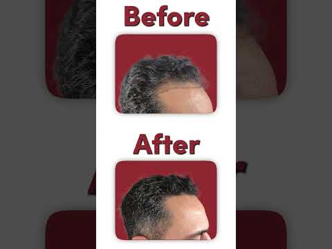 FUE hair transplant