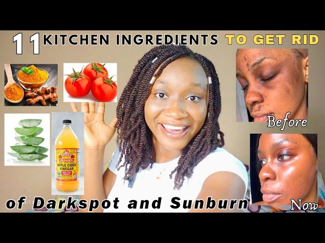 BEST NATURAL INGREDIENTS USE TO GET RID OF DARKSPOT,SUNBURN AND