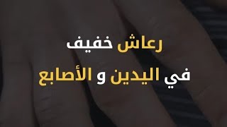 أعراض فرط نشاط الغدة الدرقية|profitness.dz