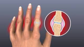 The Pain, Swelling And Stiffness of Rheumatoid Arthritis
