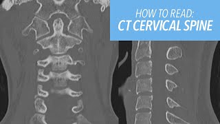 How to Read a CT of the Cervical Spine