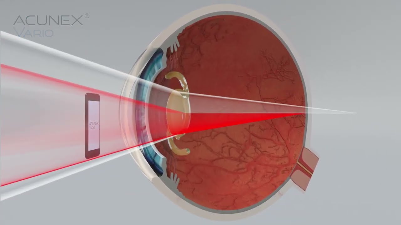 ACUNEX Vario EDoF IOL (Teleon Surgical): How does the light distribution work?