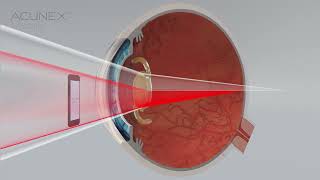 ACUNEX Vario EDoF IOL (Teleon Surgical): How does the light distribution work?