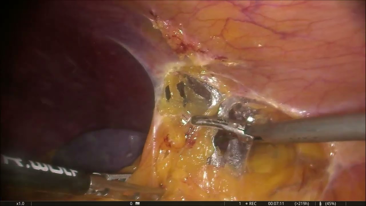 Left Laparoscopic Partial Nephrectomy