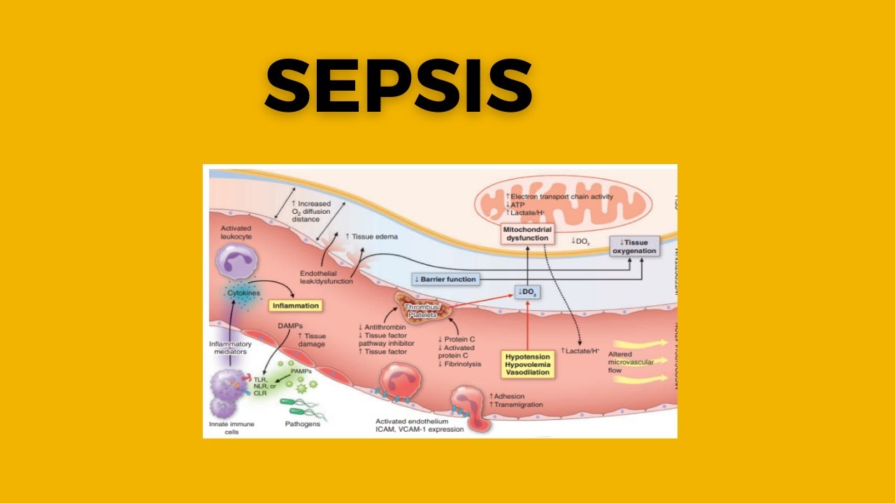 Sepsis - YouTube