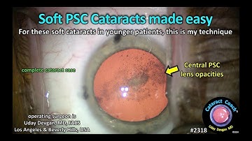 CataractCoach™ 2318: soft PSC cataracts made easy