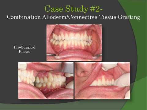 Michigan Periodontist Gum Grafting Procedures