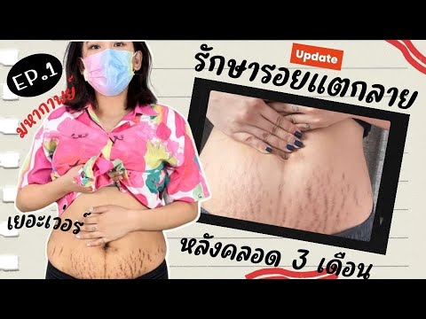 วีดีโอ: วิธีกำจัดหูดด้วยเทปพันท่อสีเทา: 9 ขั้นตอน