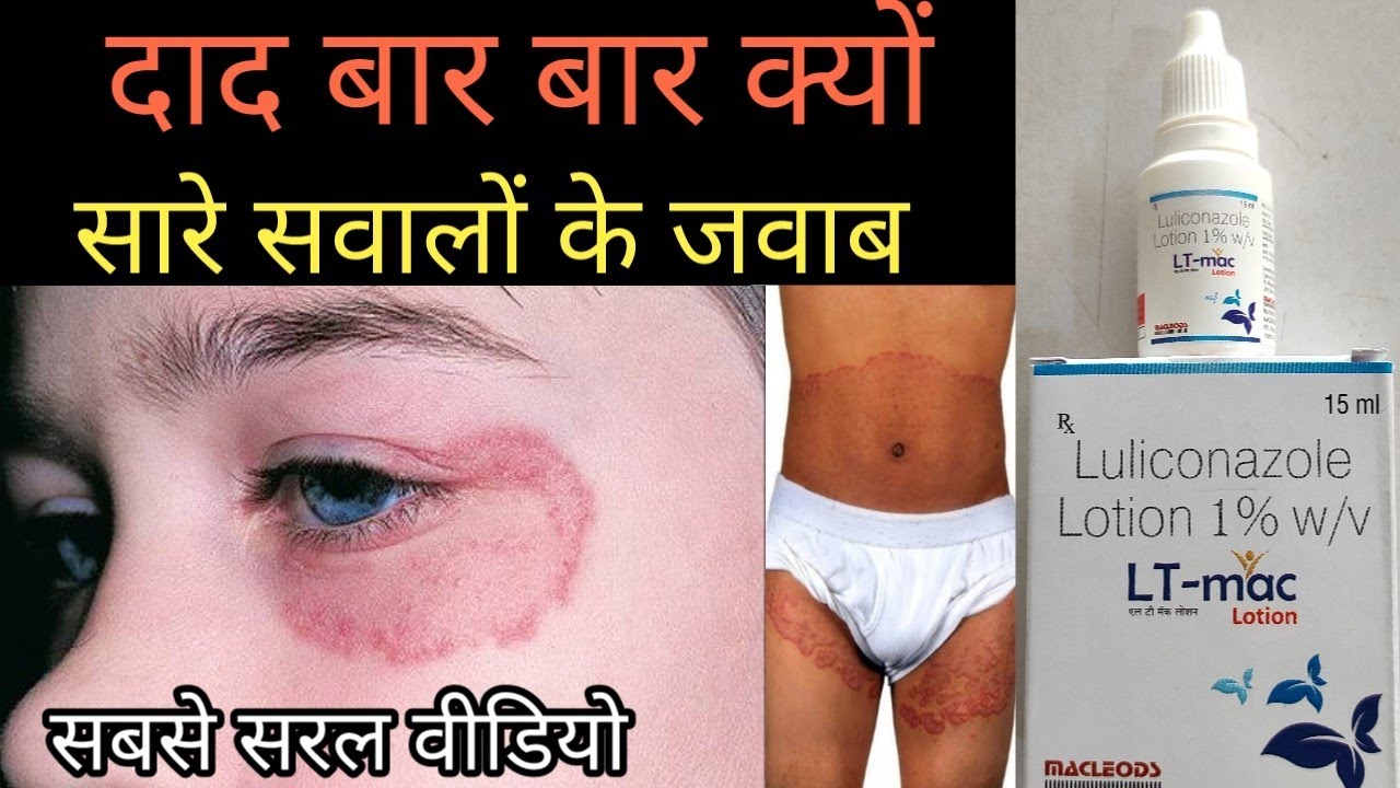 दाद का आखरी ईलाज LT Mac lotion | lulimac lotion | luliconazole lotion | fungal infection treatment