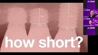 Short Implantsโฆ