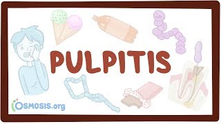Pulpitis - causes, symptoms, diagnosis, treatment, pathology