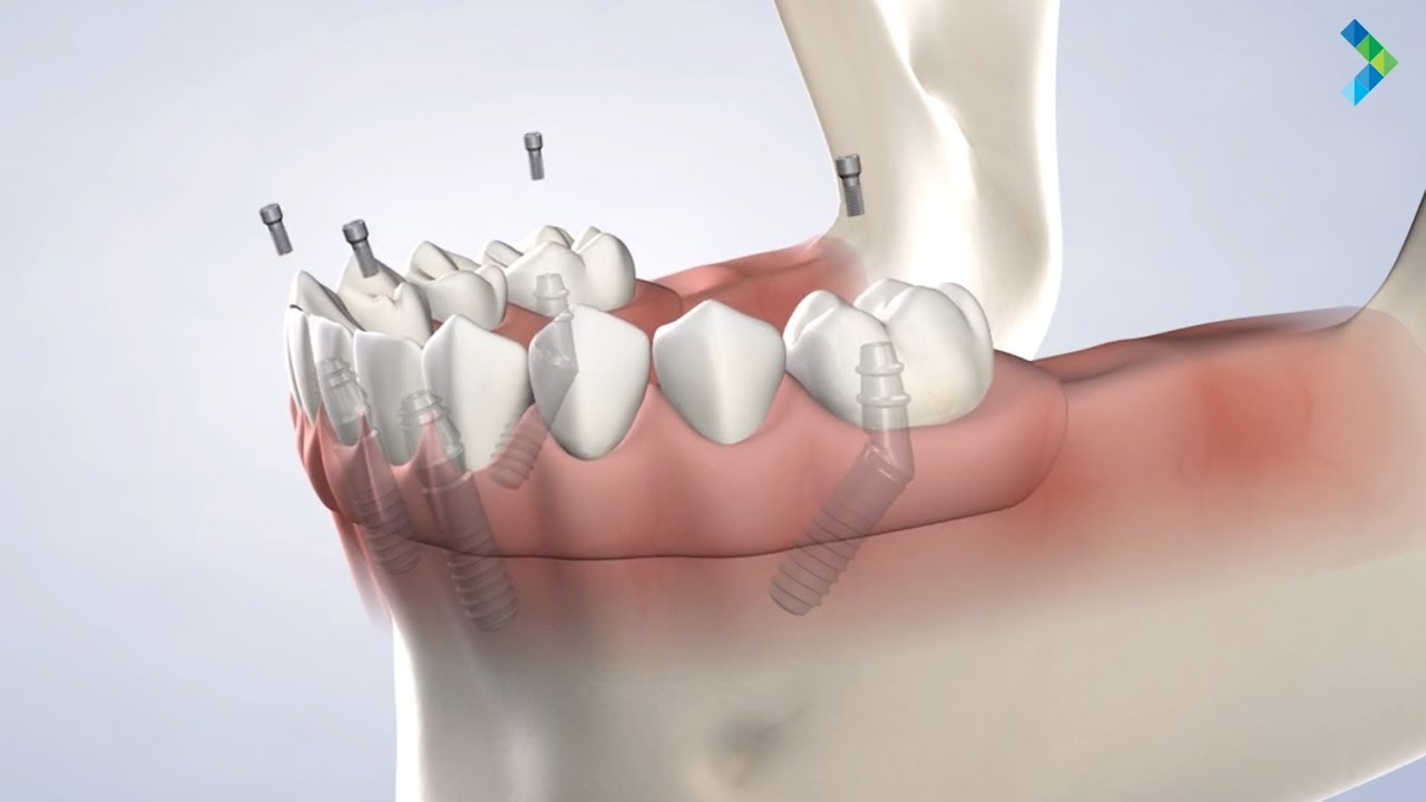 All-on-4® Treatment Concept in Danbury CT | Greater Connecticut Oral & Dental Implant Surgery